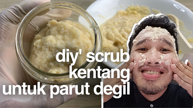 Hilangkan PARUT JERAWAT dengan berkesan guna kentang