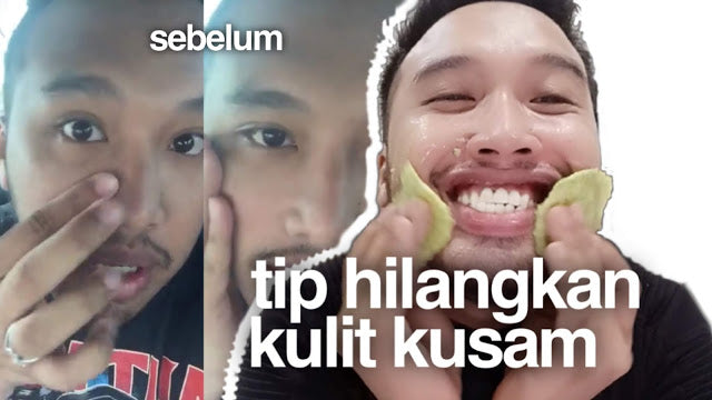 Tip hilangkan sunburn dan kulit kusam