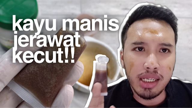 Krim Kayu Manis untuk kecutkan Jerawat (Proven Result)