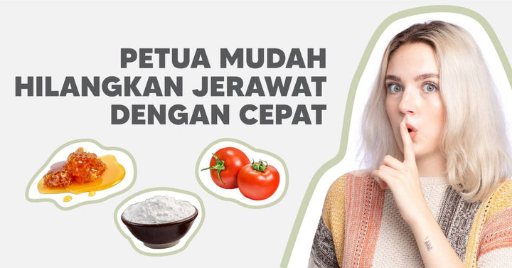 PETUA MUDAH HILANGKAN JERAWAT DENGAN CEPAT